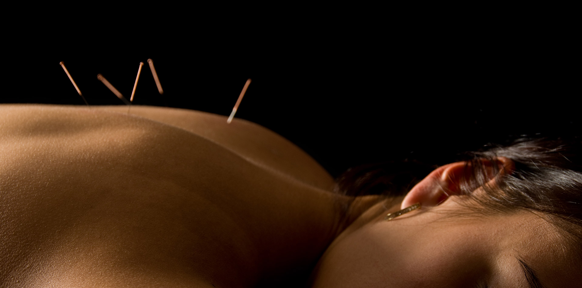 Acupuncture for Stress!