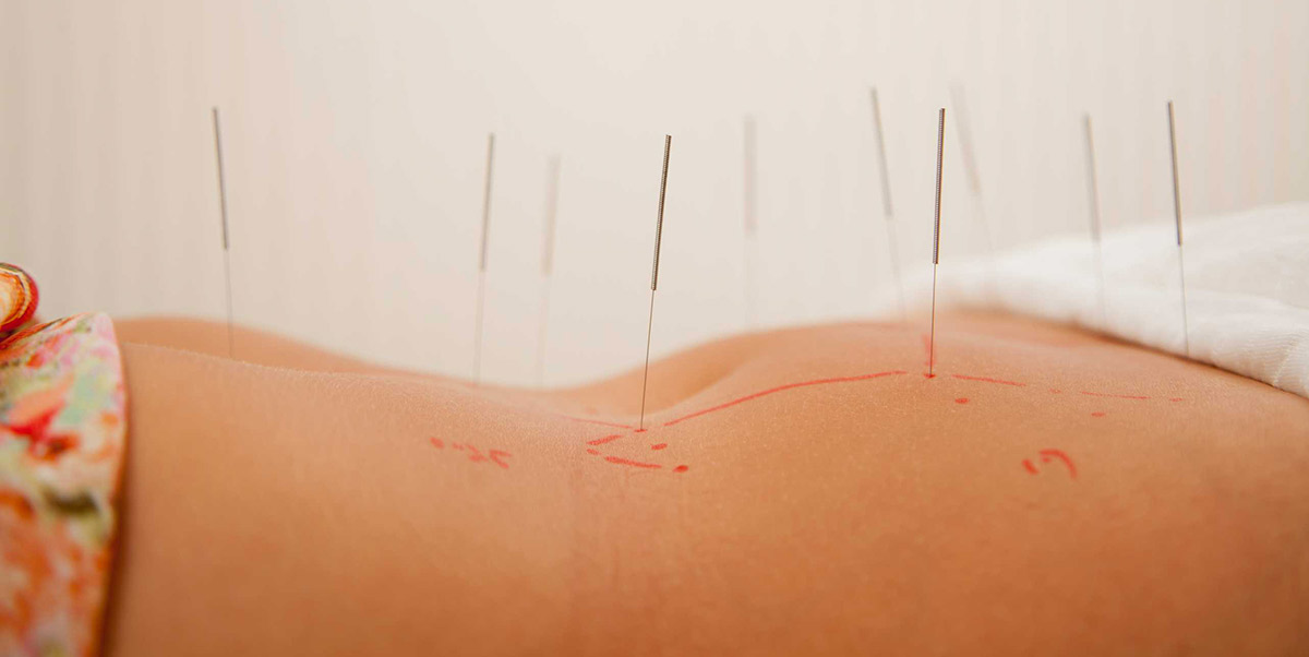 Menstrual and Lymphatic Acupuncture
