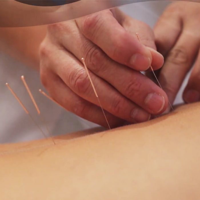 Combatting Stress Using Acupuncture